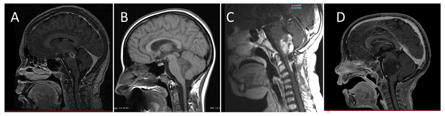 뇌간 신경교종 MRI 분류