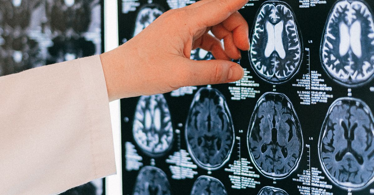 뇌졸중 예방 영상을 나타내는 뇌 MRI 스캔