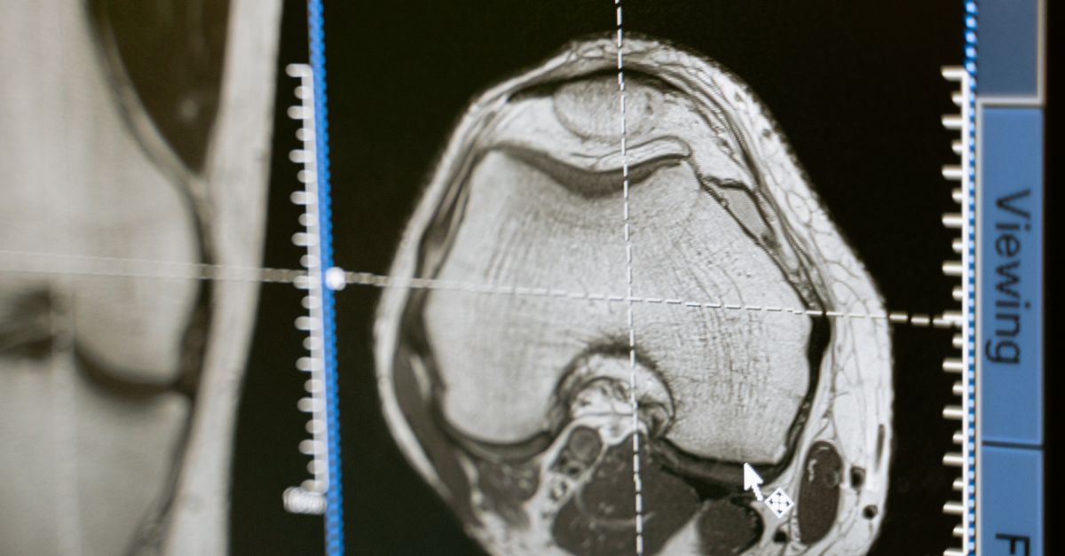영상 유도 치료를 나타내는 의료 모니터의 MRI 스캔
