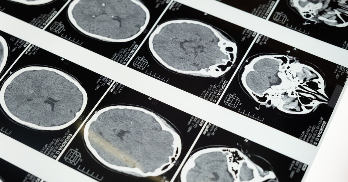 조명판에 표시된 뇌 MRI 스캔 이미지. 뇌졸중 영상의학과 예후 평가를 나타냄.
