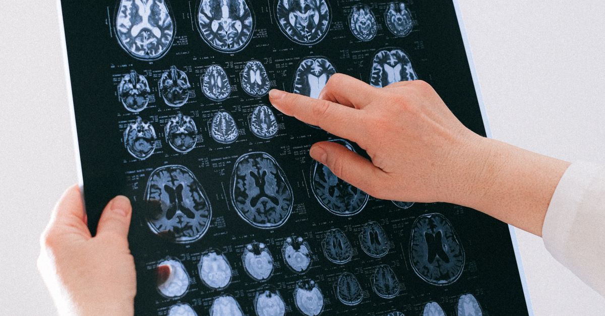 의료 전문가가 뇌 MRI 스캔을 검사하는 이미지. 뇌졸중 임상 시험을 나타냄.