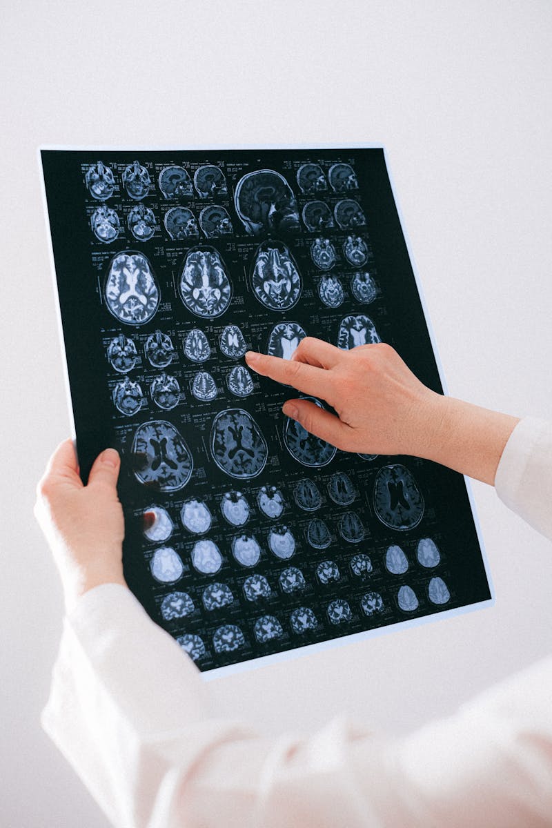 알츠하이머 진단을 위한 뇌 MRI 스캔